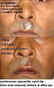 Before After Pictures,Cosmetic surgery,Delhi,endoscopic cysticercus lip removal